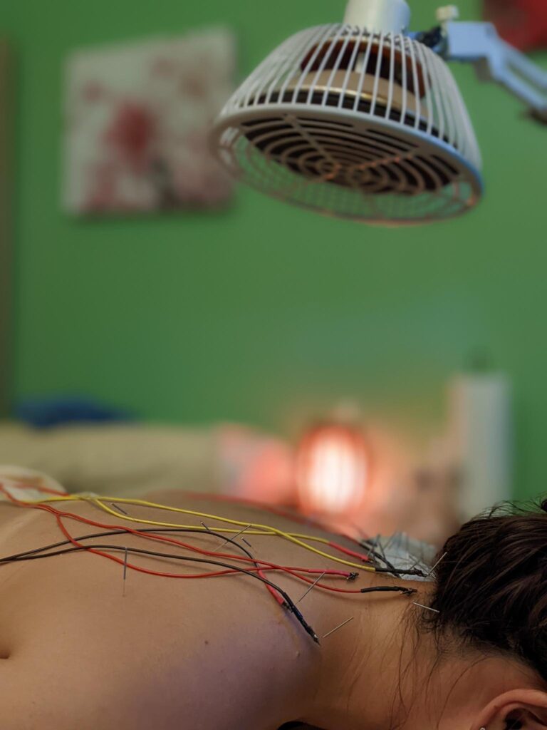 Woman getting electro-acupuncture treatment with heat therapy on her upper back